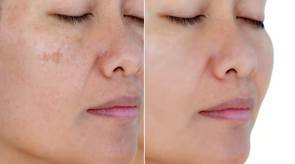 anti aging treatment