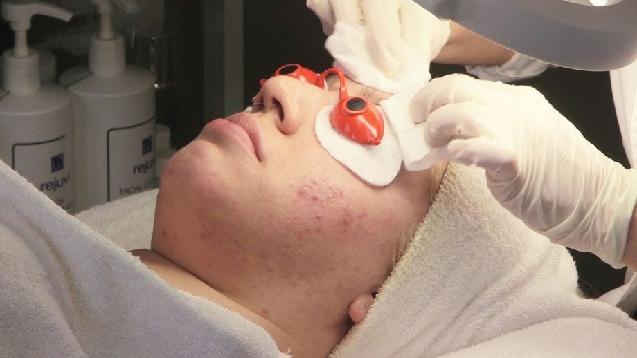 acne facial singapore