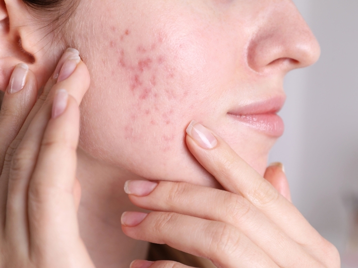 best pimple cream for Acne Scars and Post-Acne Marks