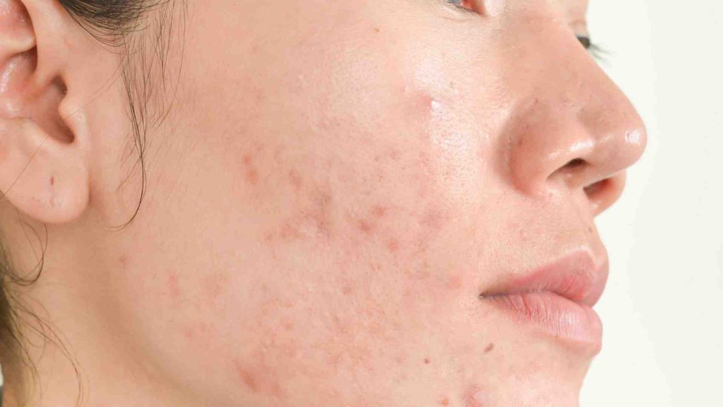 Acne Scarring