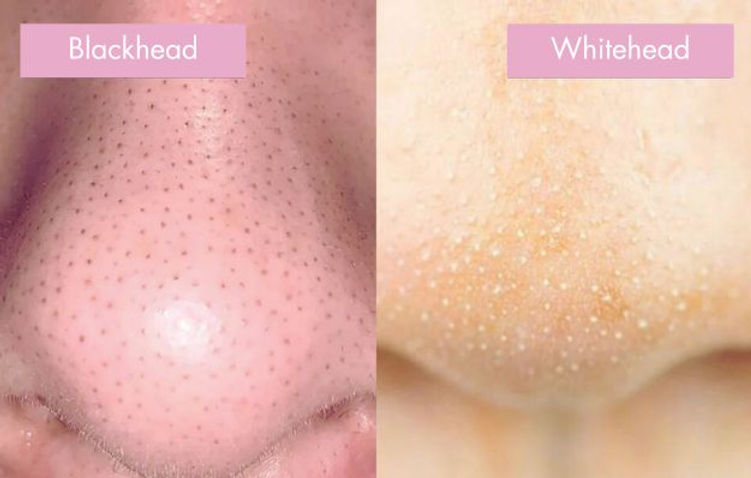 blackhead and whitehead removal with acne facial