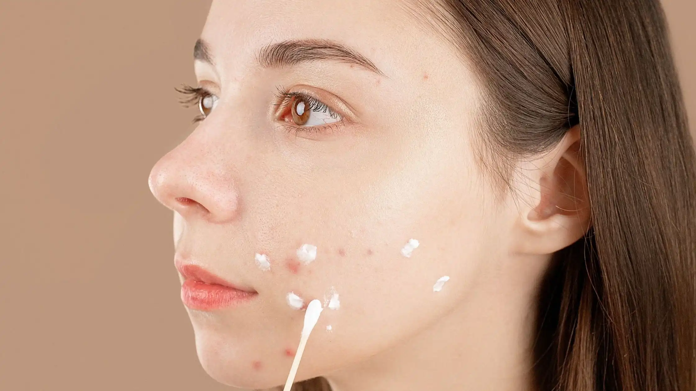 The Ultimate Guide to Finding the Best Pimple Cream in Singapore