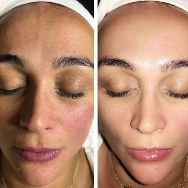 Cryo Lifting Before and After