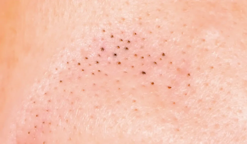 blackhead removal singapore
