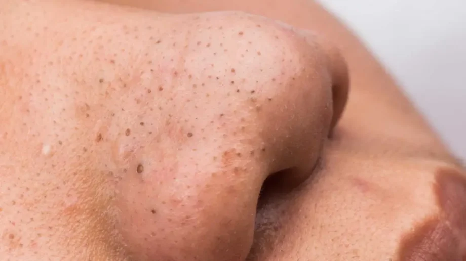 blackhead removal singapore