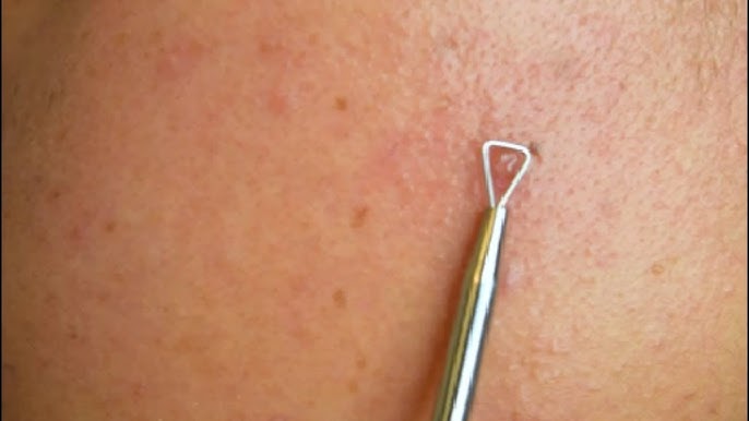 blackhead removal tool
