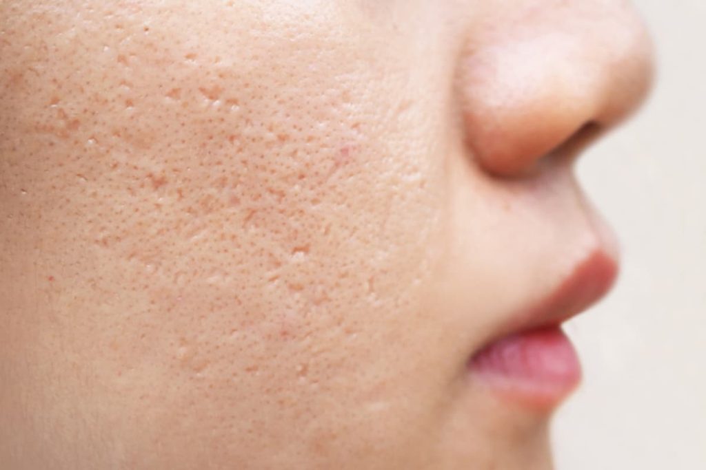 Acne Scar Treatment in Singapore