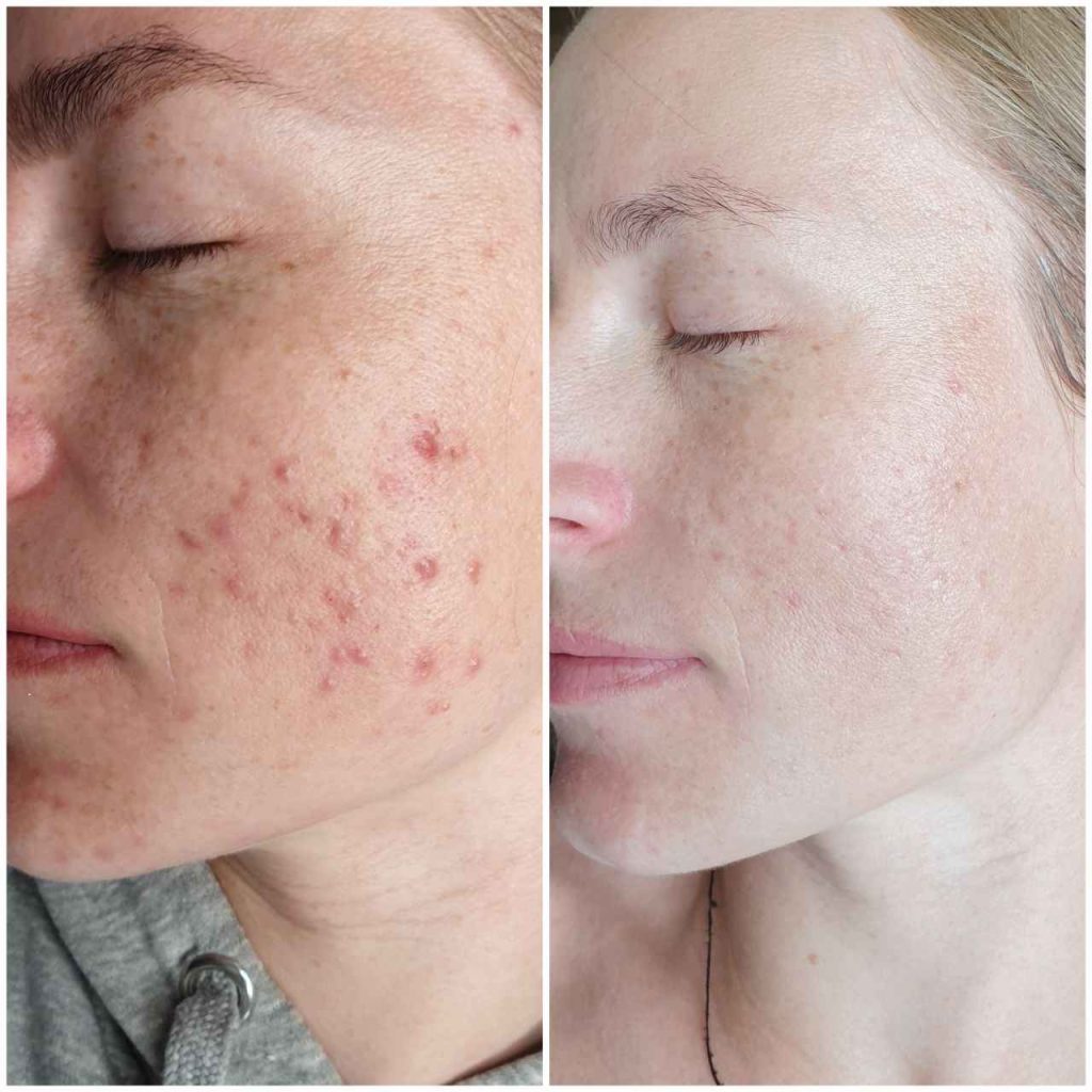 Cold Plasma Treatment Before and After