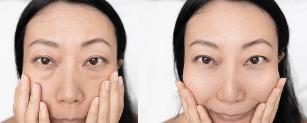 eyebag removal