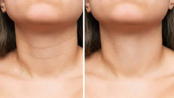 neck line treatment before after
