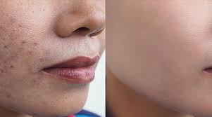 Effective Skin Pigmentation Removal Treatments for the Face