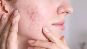 How to Reduce Acne Redness Effectively at Home