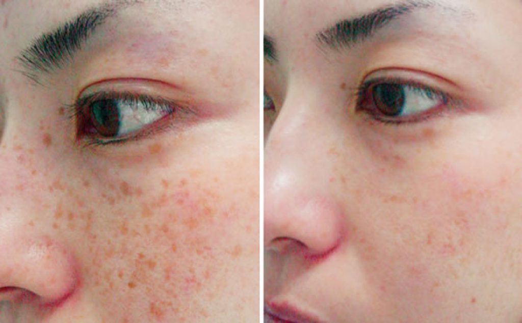 skin pigmentation removal