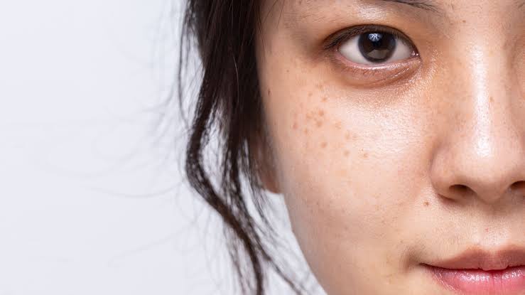 Hyperpigmentation Treatment Results: A Realistic Timeline
